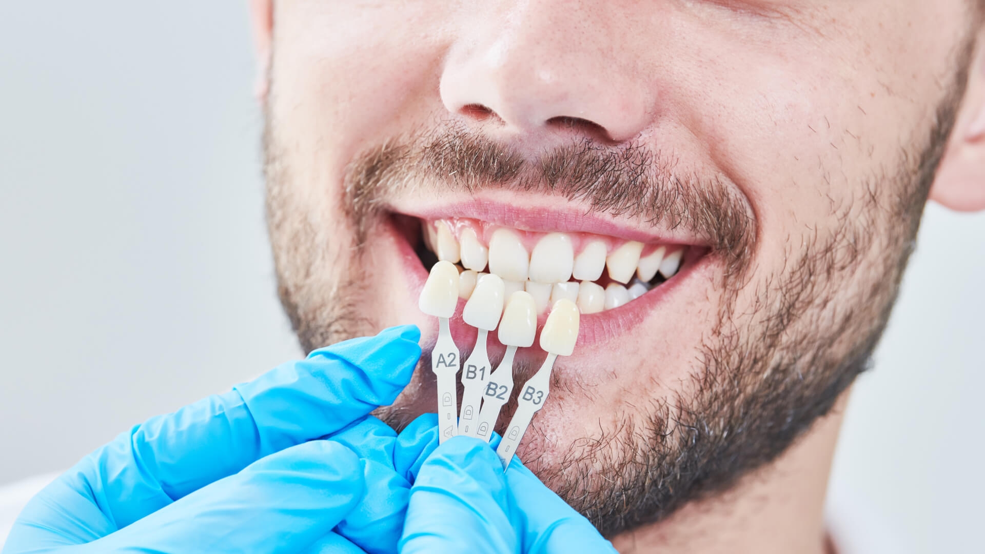 пошаговый процесс установки керамических виниров на зубы в стоматологии