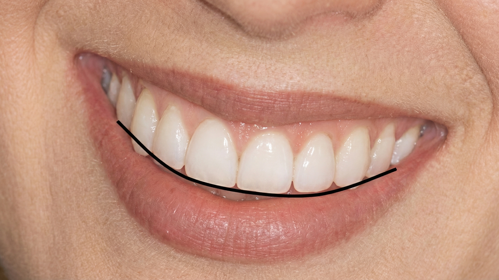 blog-hollywood-smile-without-veneers-007.jpg