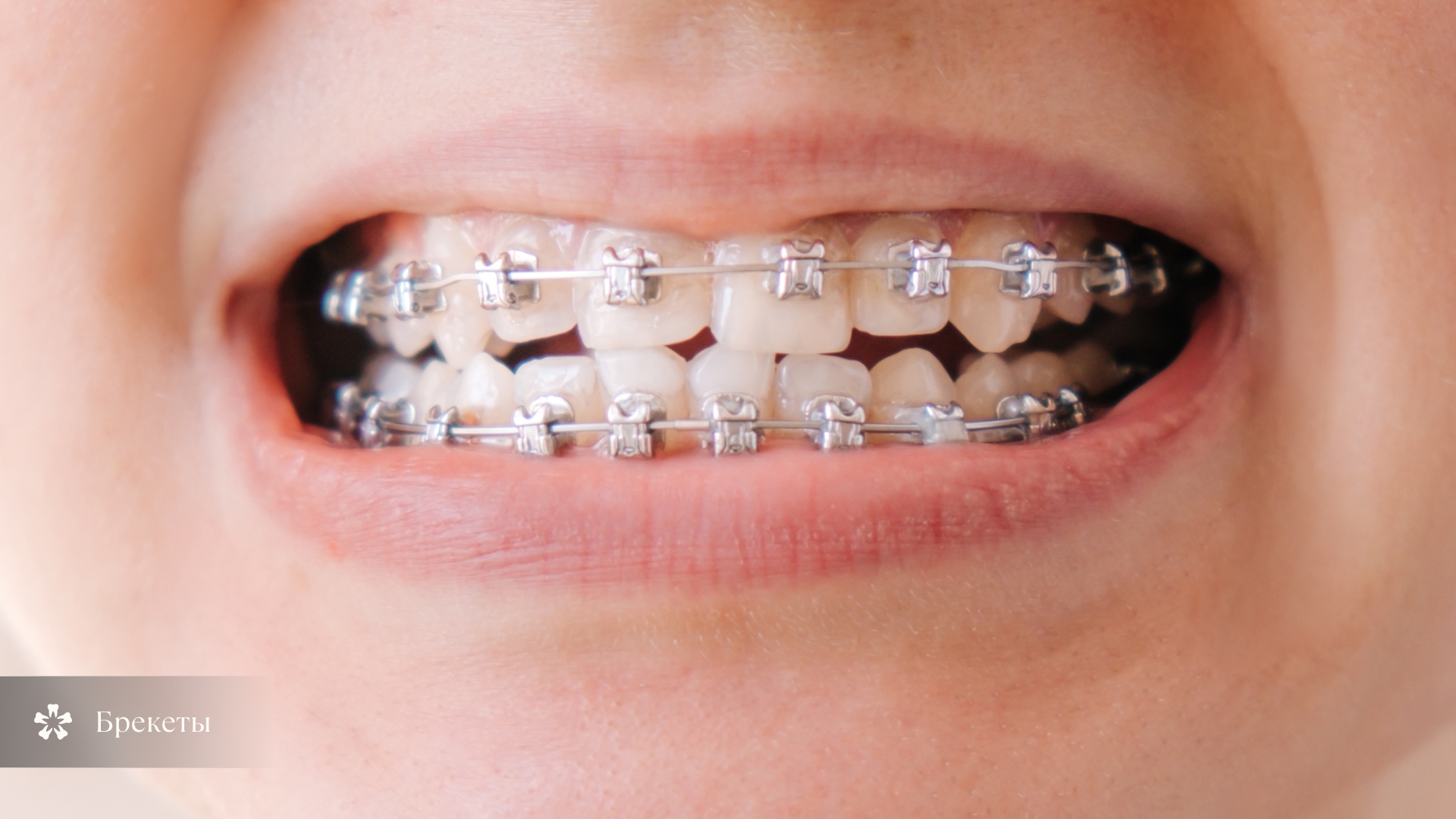 Система брекетов
