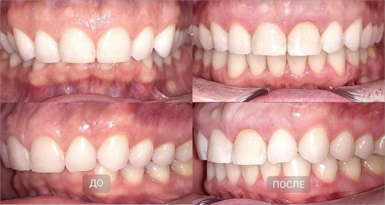 Исправление дистального прикуса элайнерами