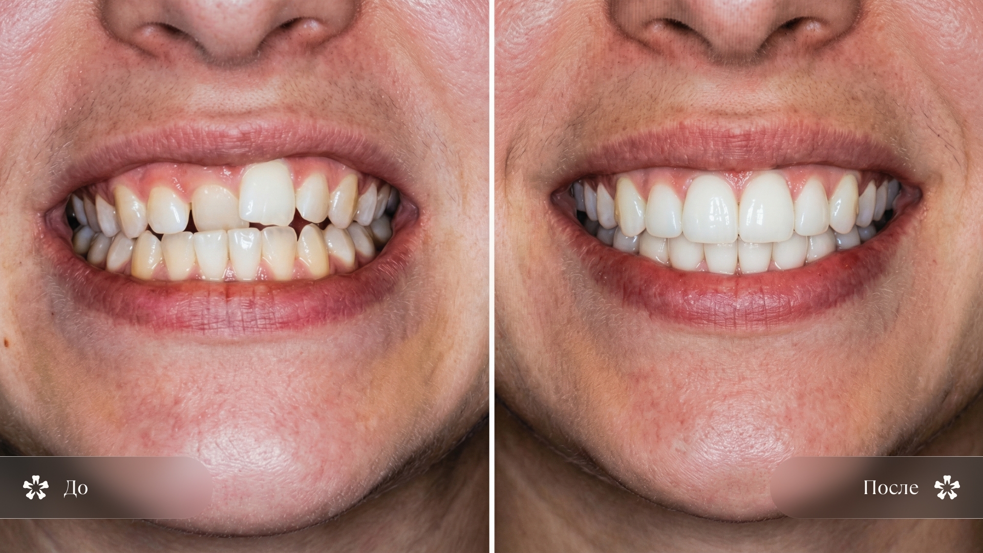 Иллюстрация результата ортодонтического лечения: сравнение улыбки до и после выравнивания зубов
