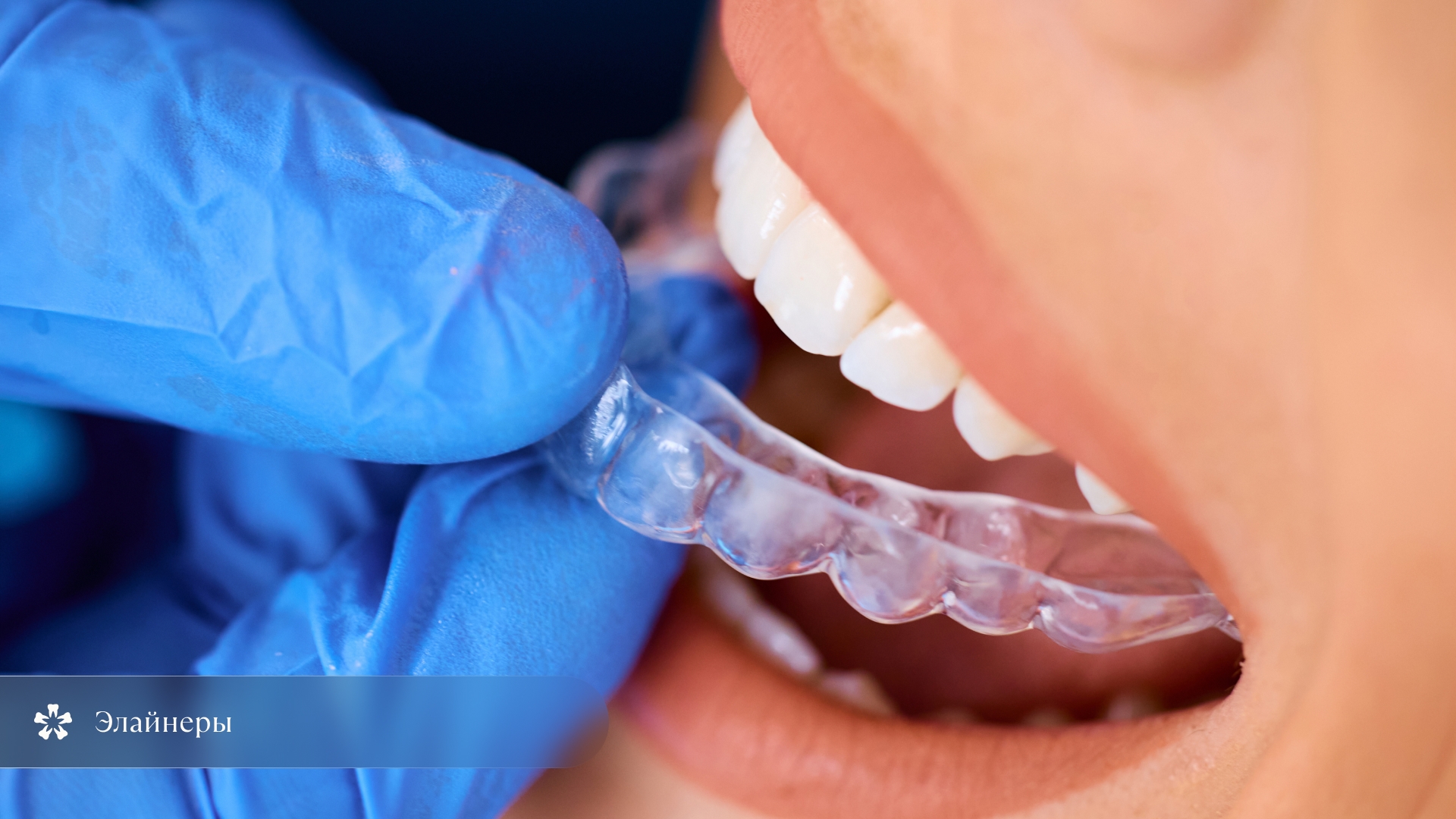 Иллюстрация установки элайнера на зубы во время ортодонтического лечения