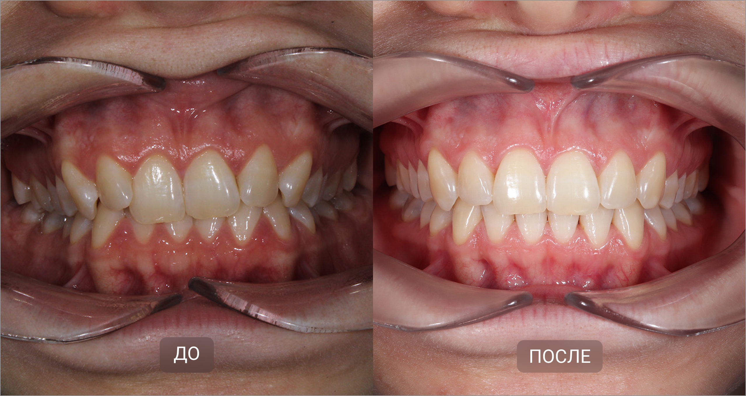 Исправление глубокого прикуса элайнерами