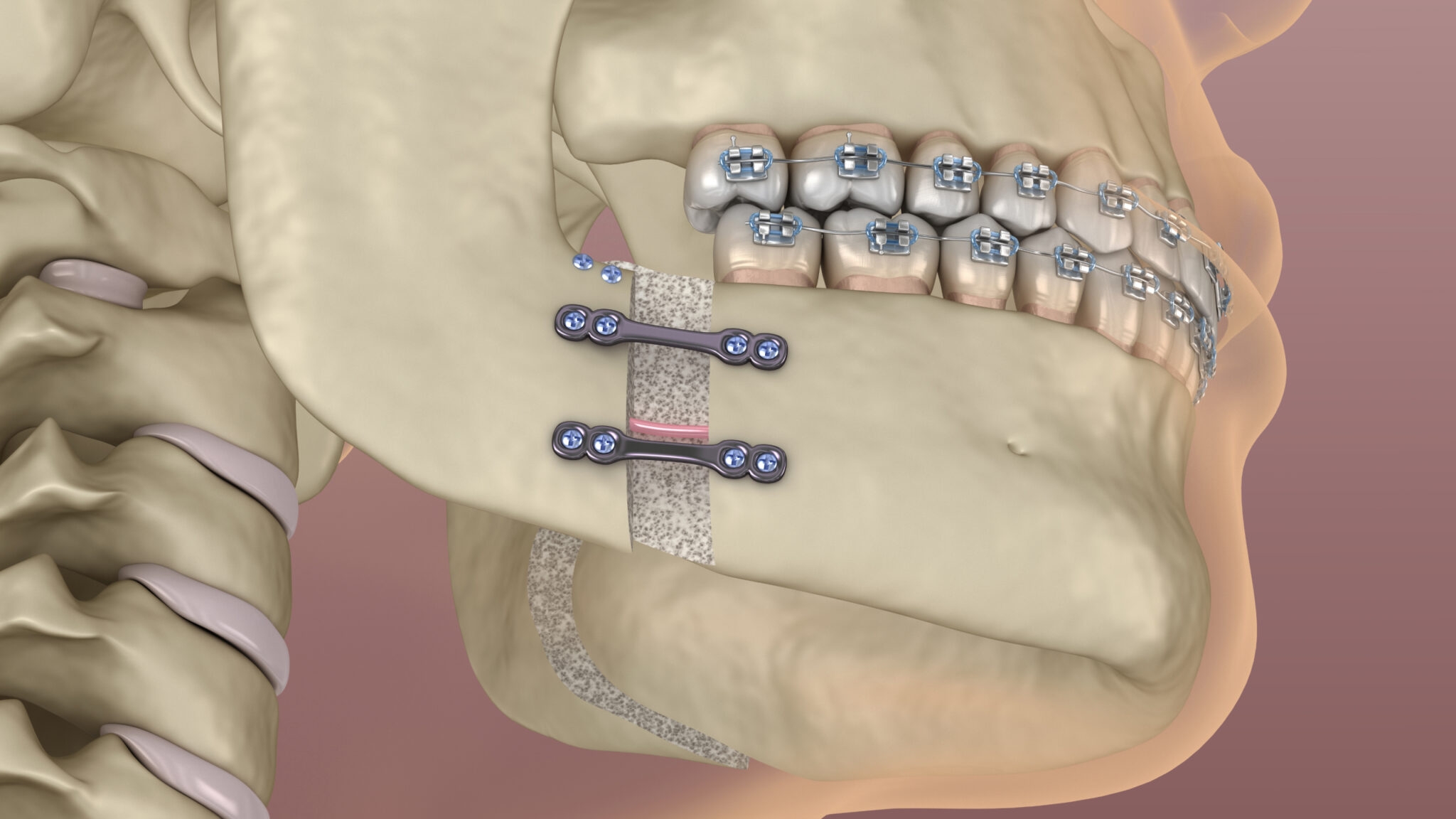 Хирургическое вмешательство при исправлении прикуса