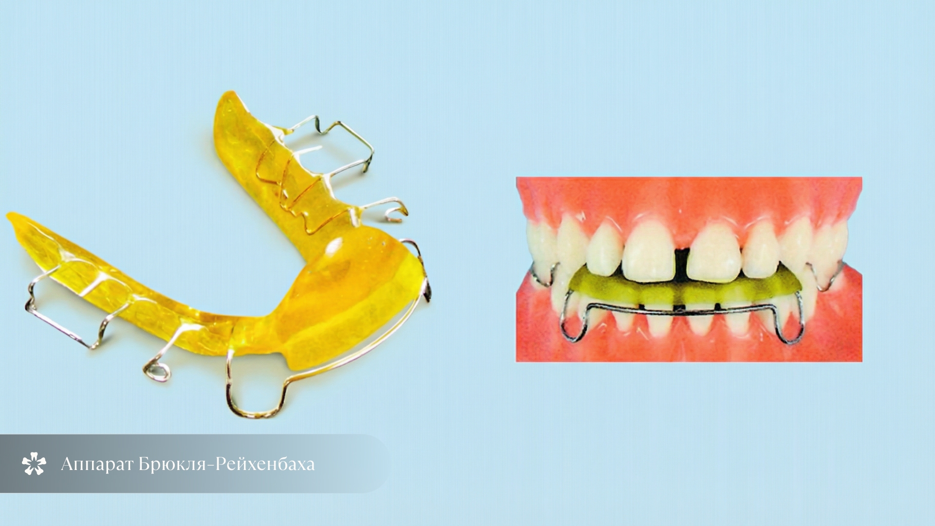 Аппарат Брюкля