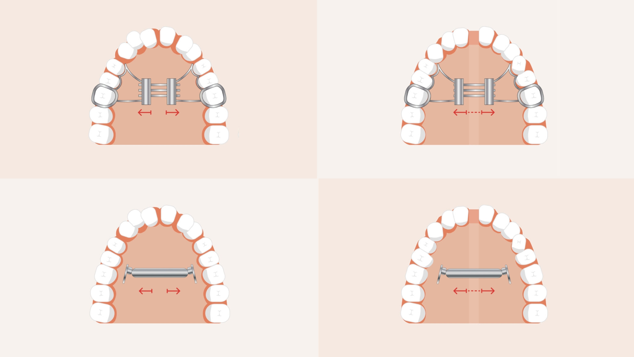 Исправление прикуса небным расширителем