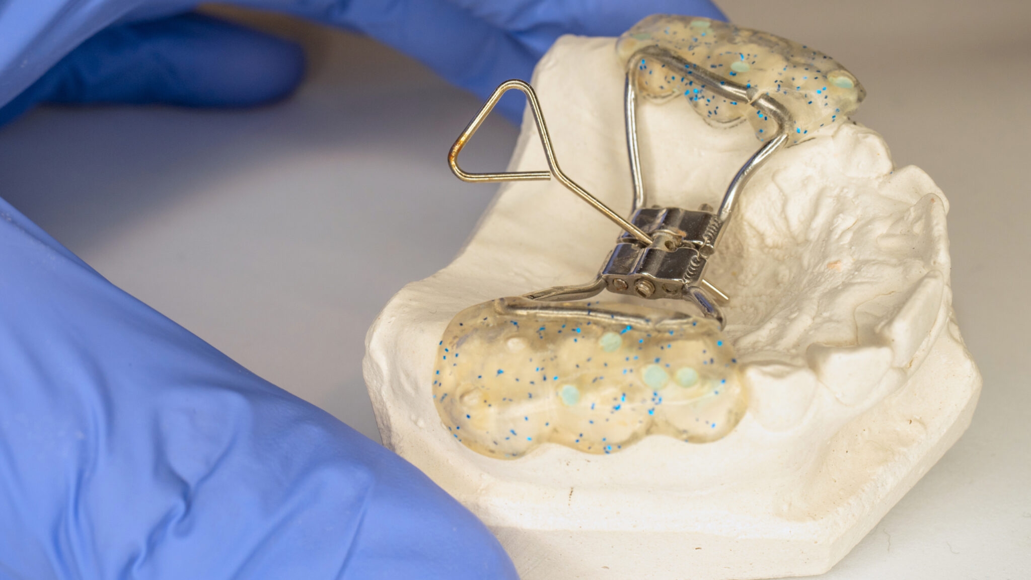 Исправление прикуса небным расширителем