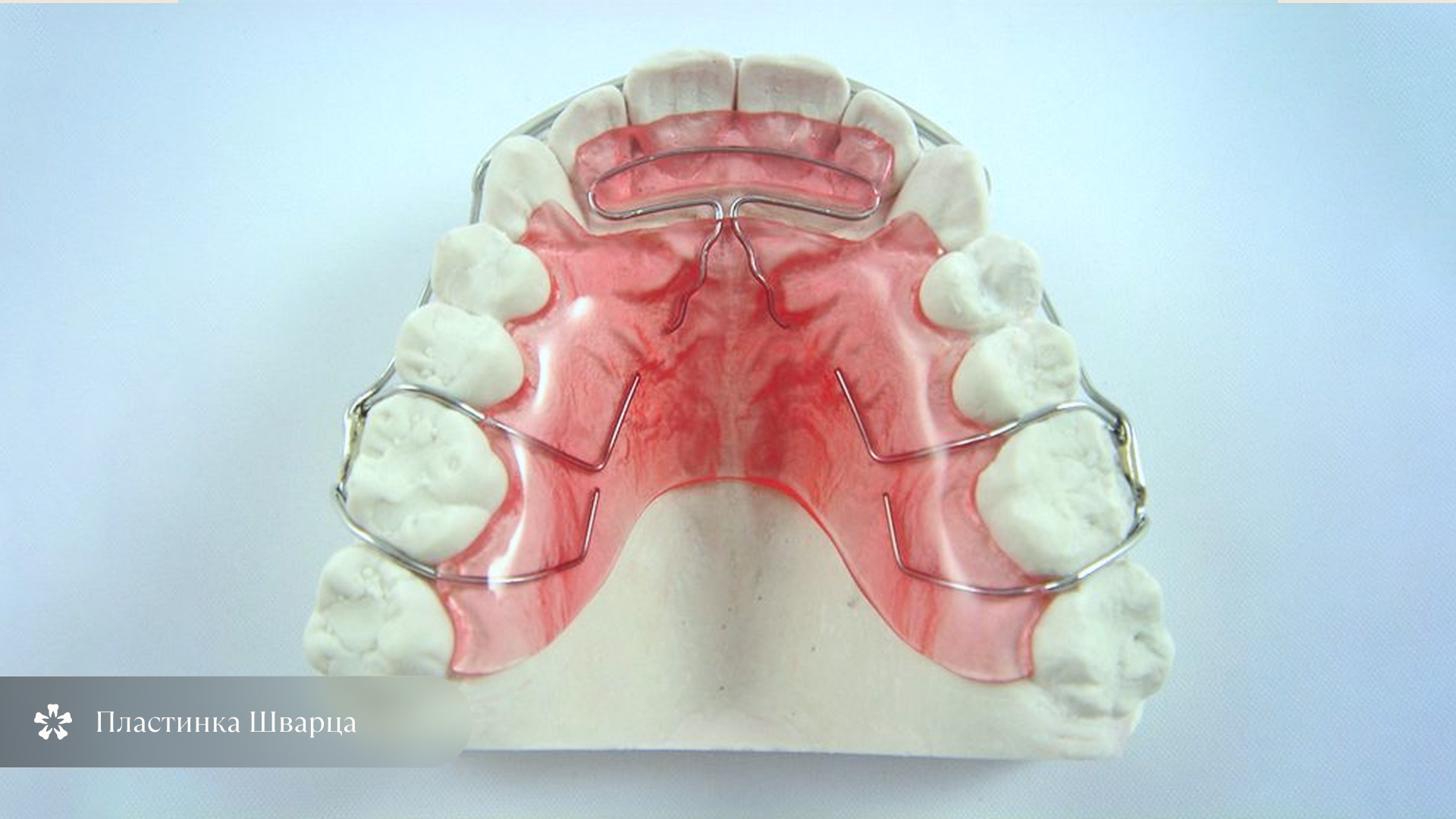 Ортодонтическая пластинка Шварца для коррекции открытого прикуса у ребёнка