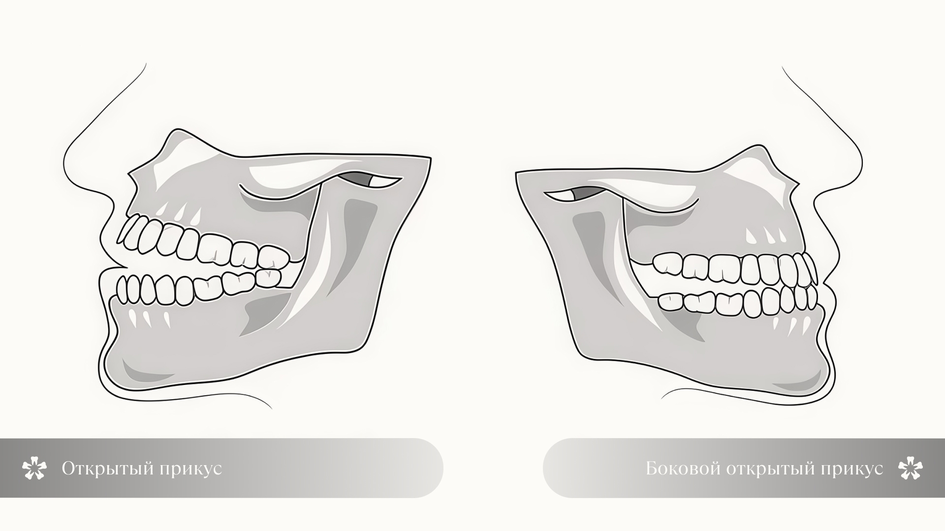 Схематичное изображение открытого и бокового открытого прикуса
