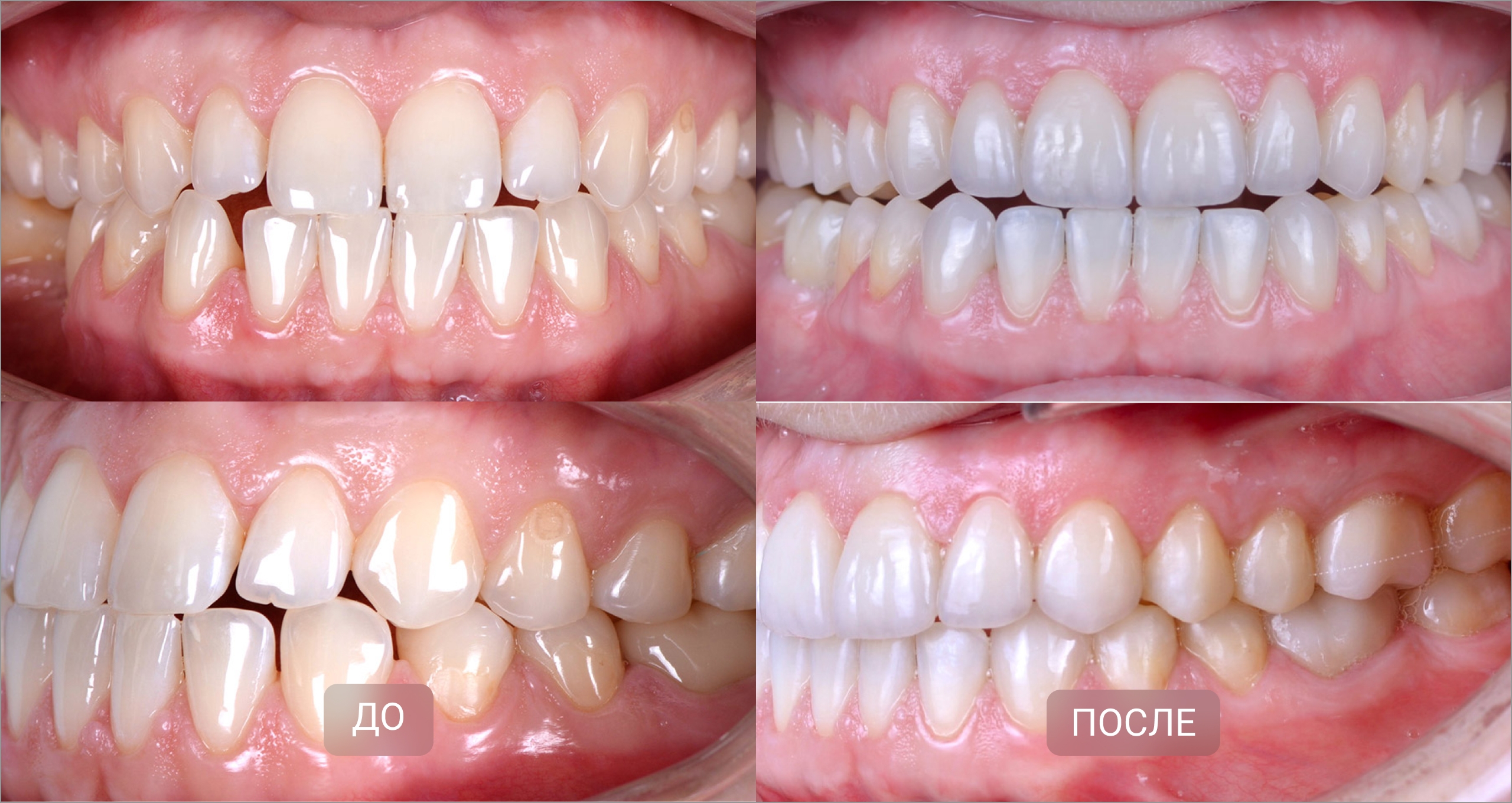 Исправление мезиального прикуса элайнерами