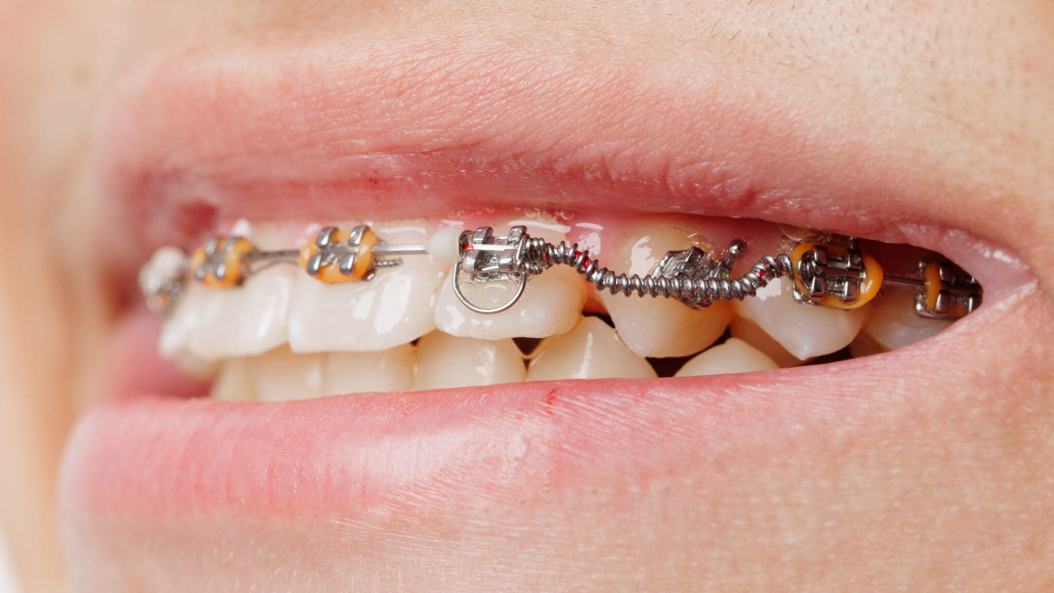 Исправление прикуса Ортодонтическими пружинами