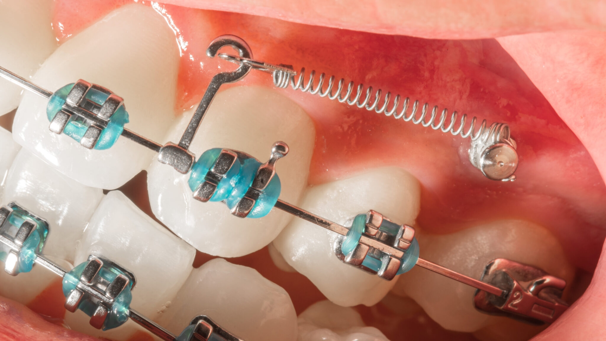 Исправление прикуса Ортодонтическими пружинами