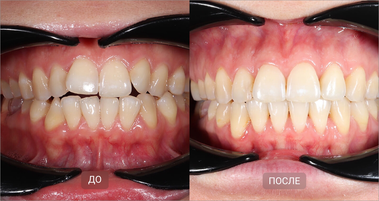 Исправление открытого прикуса элайнерами