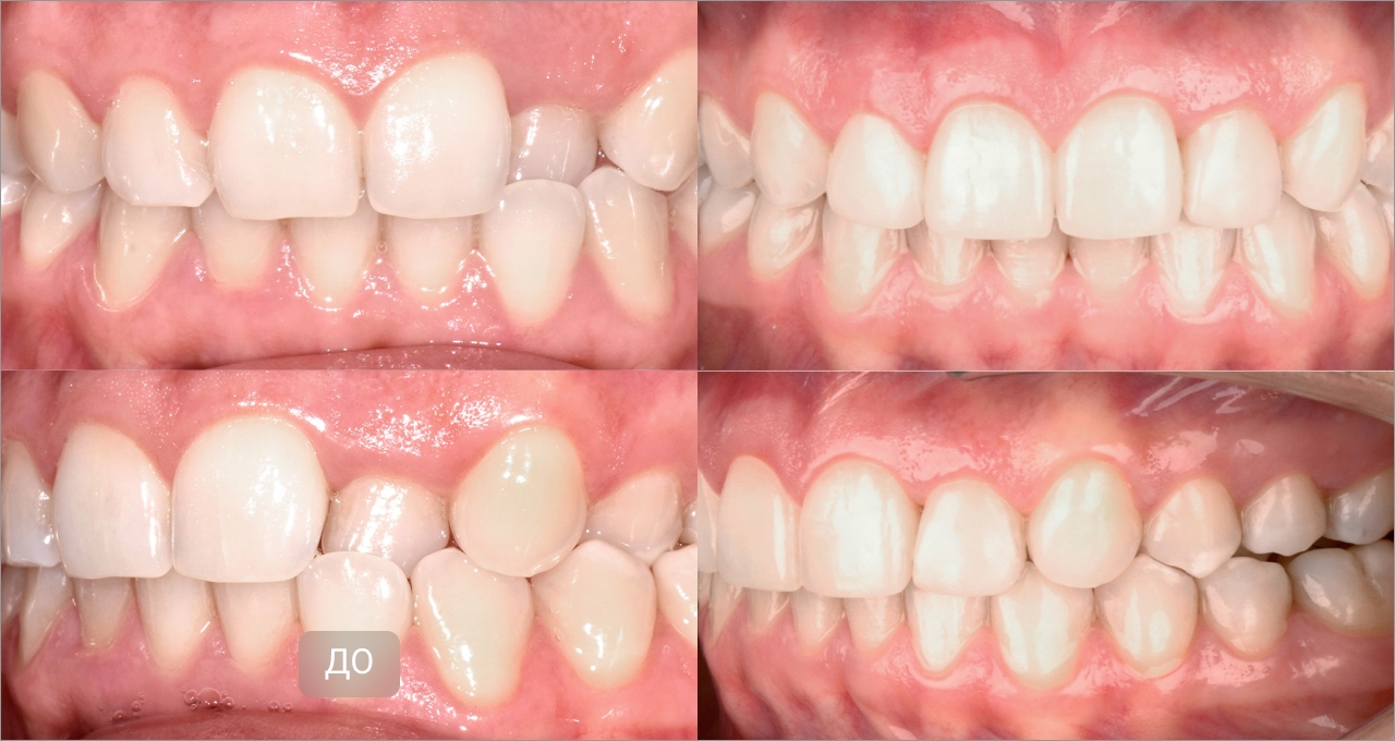 Исправление перекрестного прикуса элайнерами