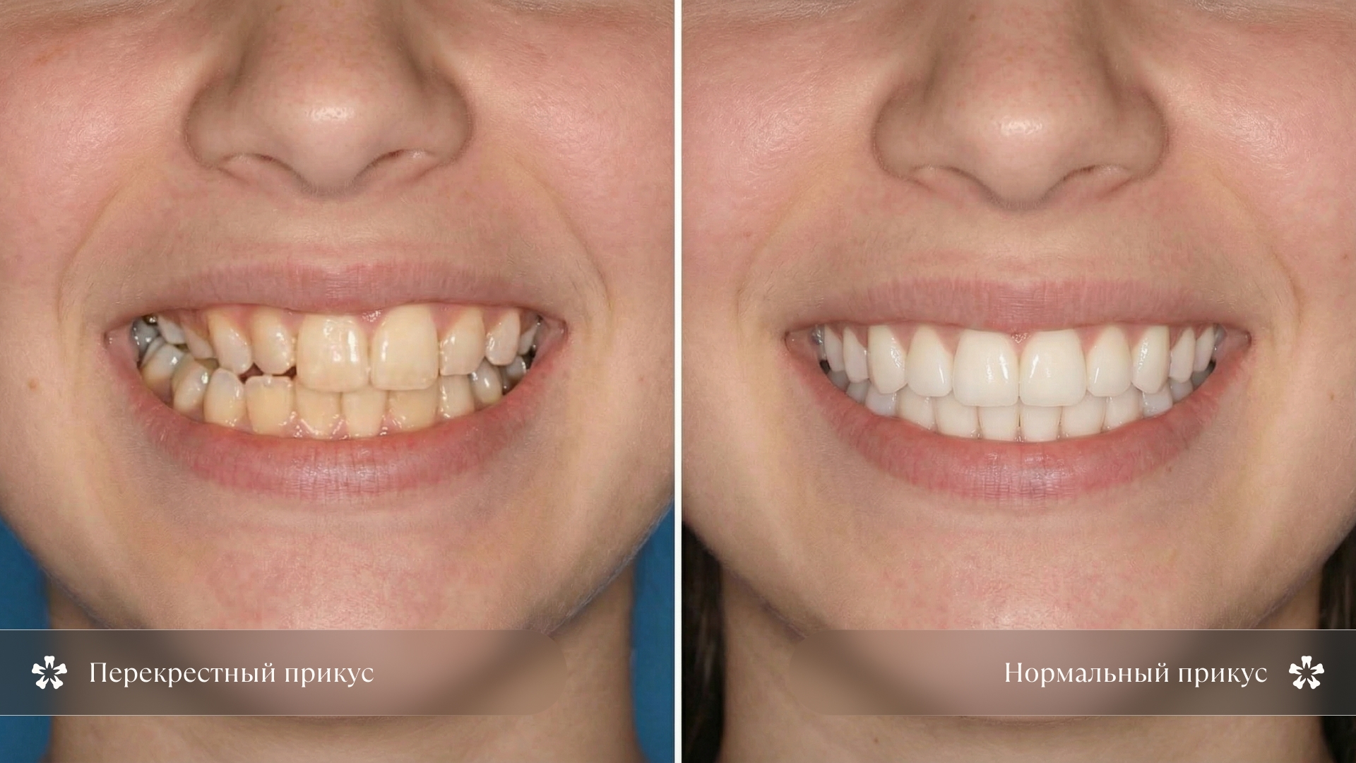 Иллюстрация сравнения перекрёстного и нормального прикуса на примере улыбки
