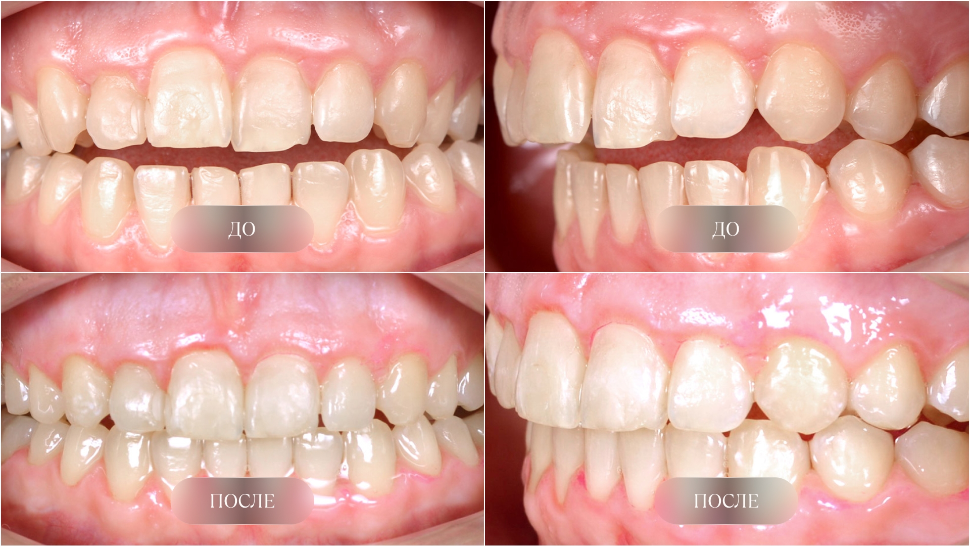 Исправление открытого прикуса у ребёнка — результат лечения элайнерами FlexiLigner до и после