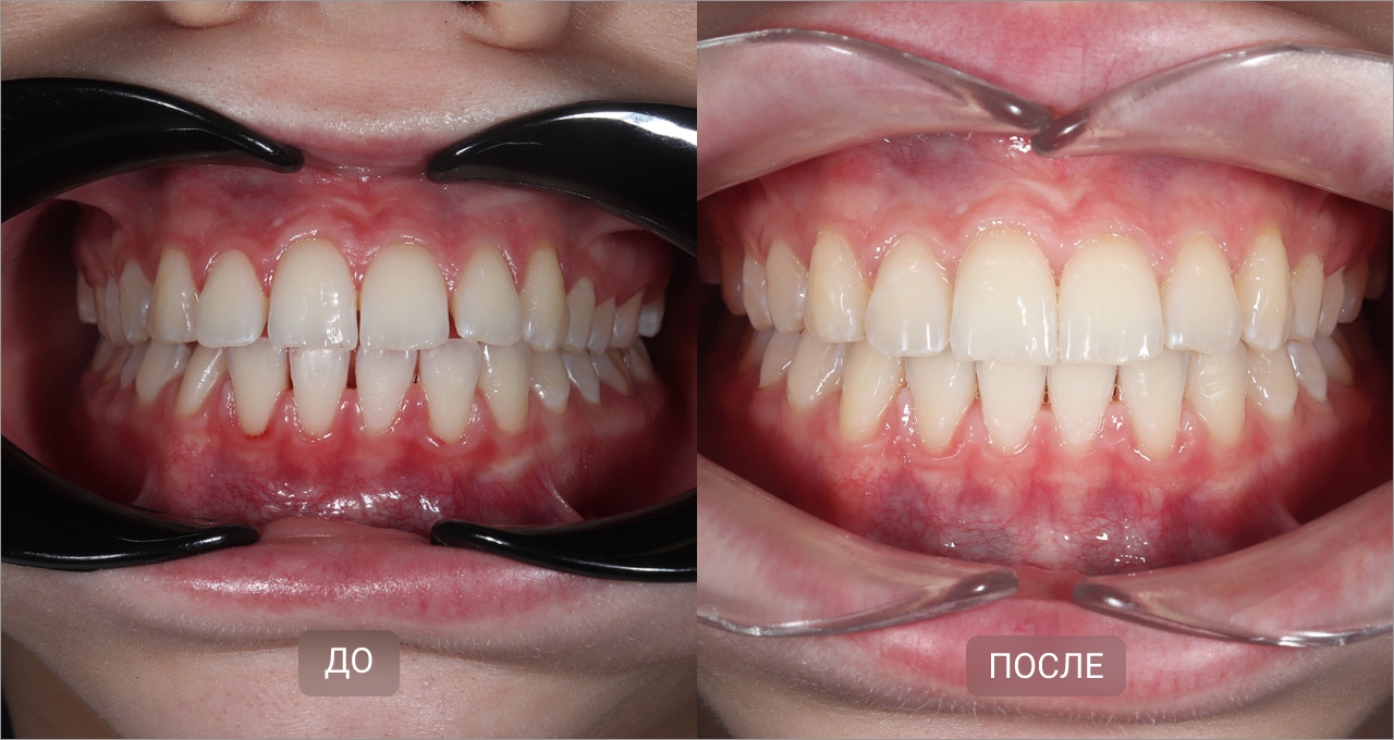 Исправление промежутков элайнерами