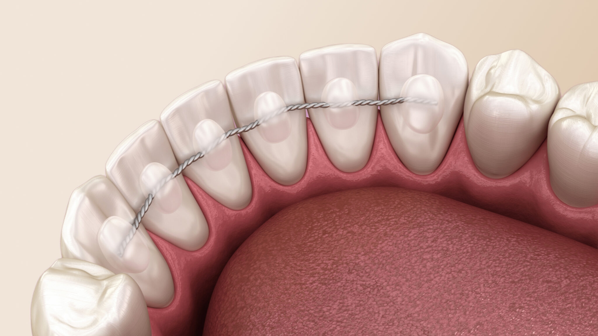 Исправление прикуса Ретейнерами