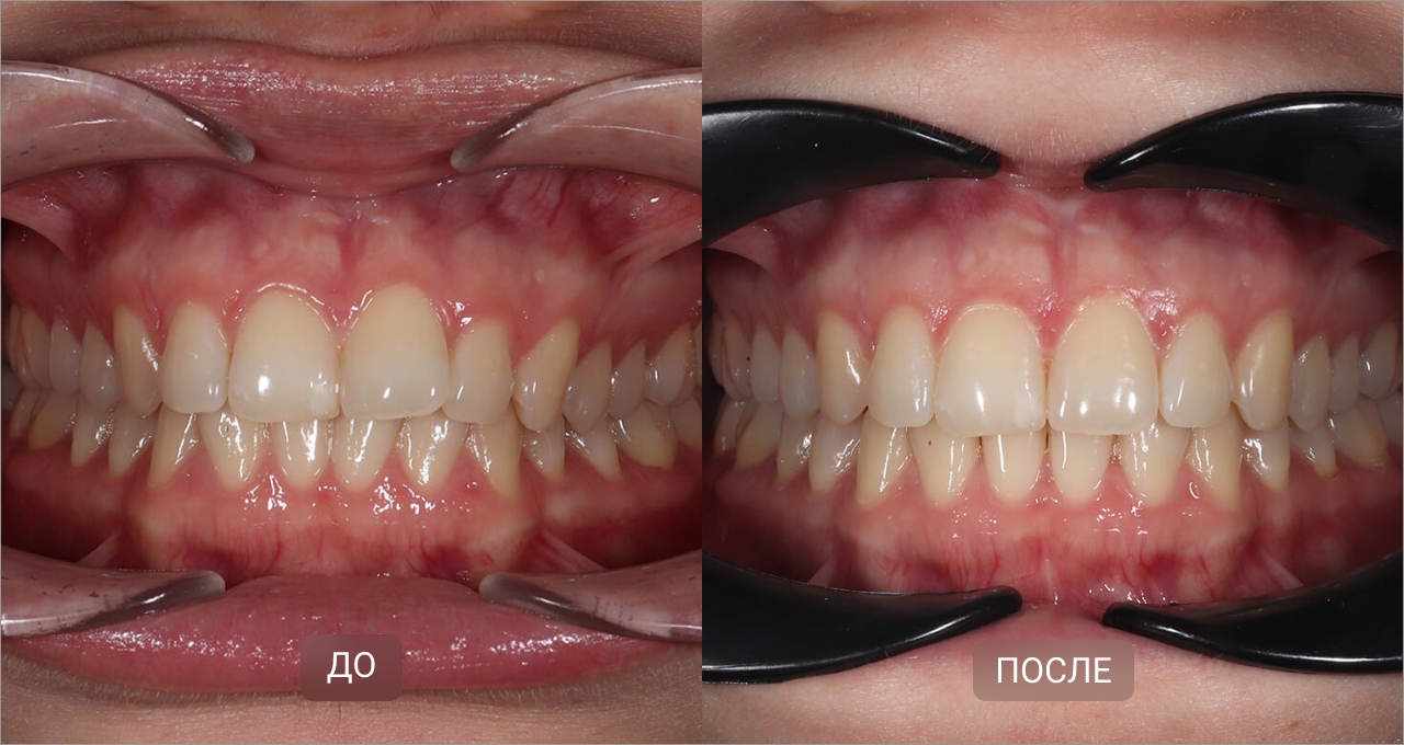 Исправление скученности элайнерами