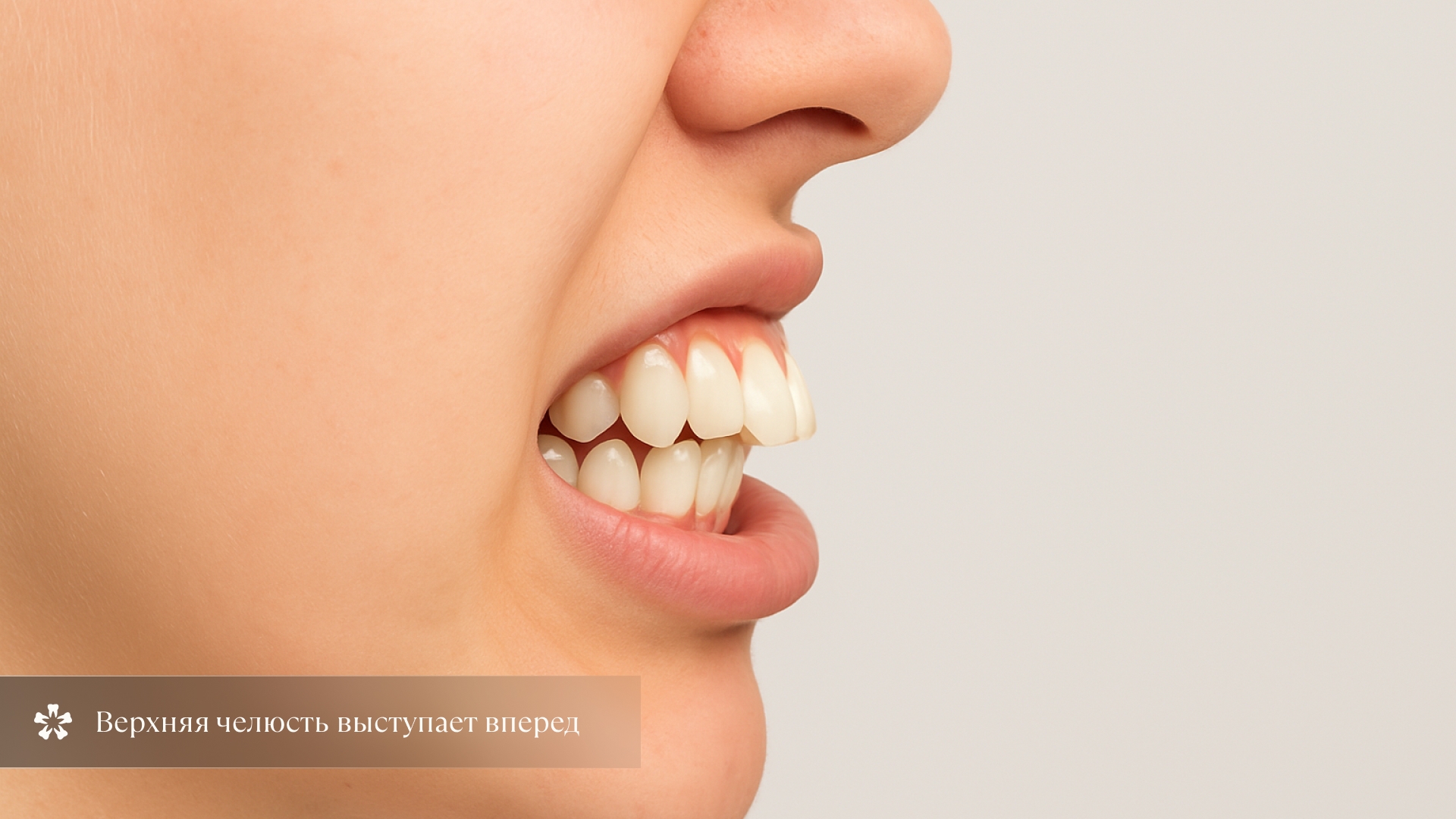Верхняя челюсть выступает вперед