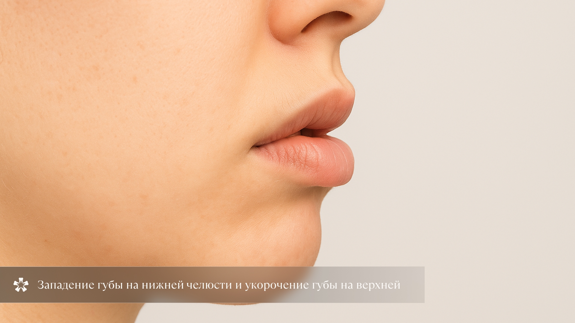 Западение губы на нижней челюсти