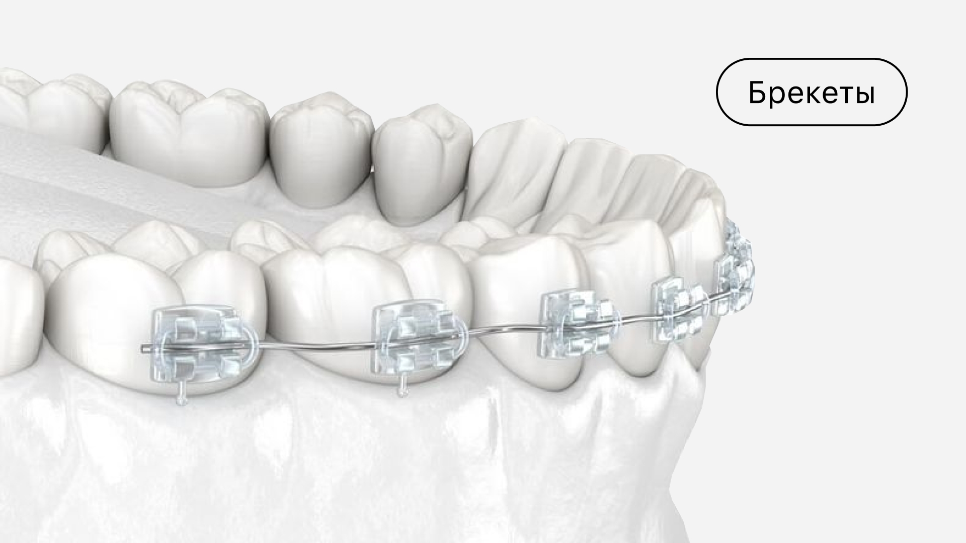 Брекеты