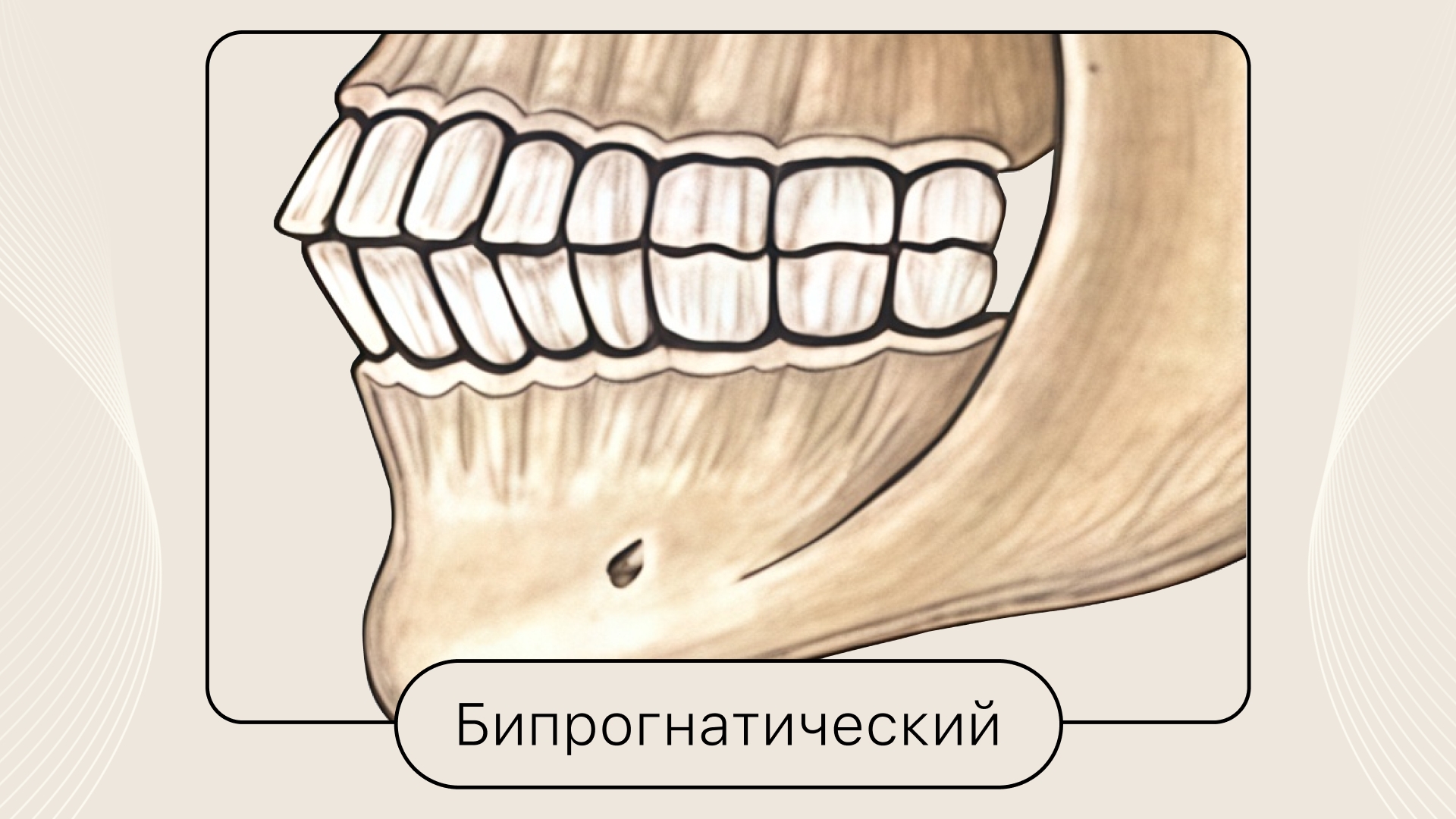 Бипрогнатический прикус