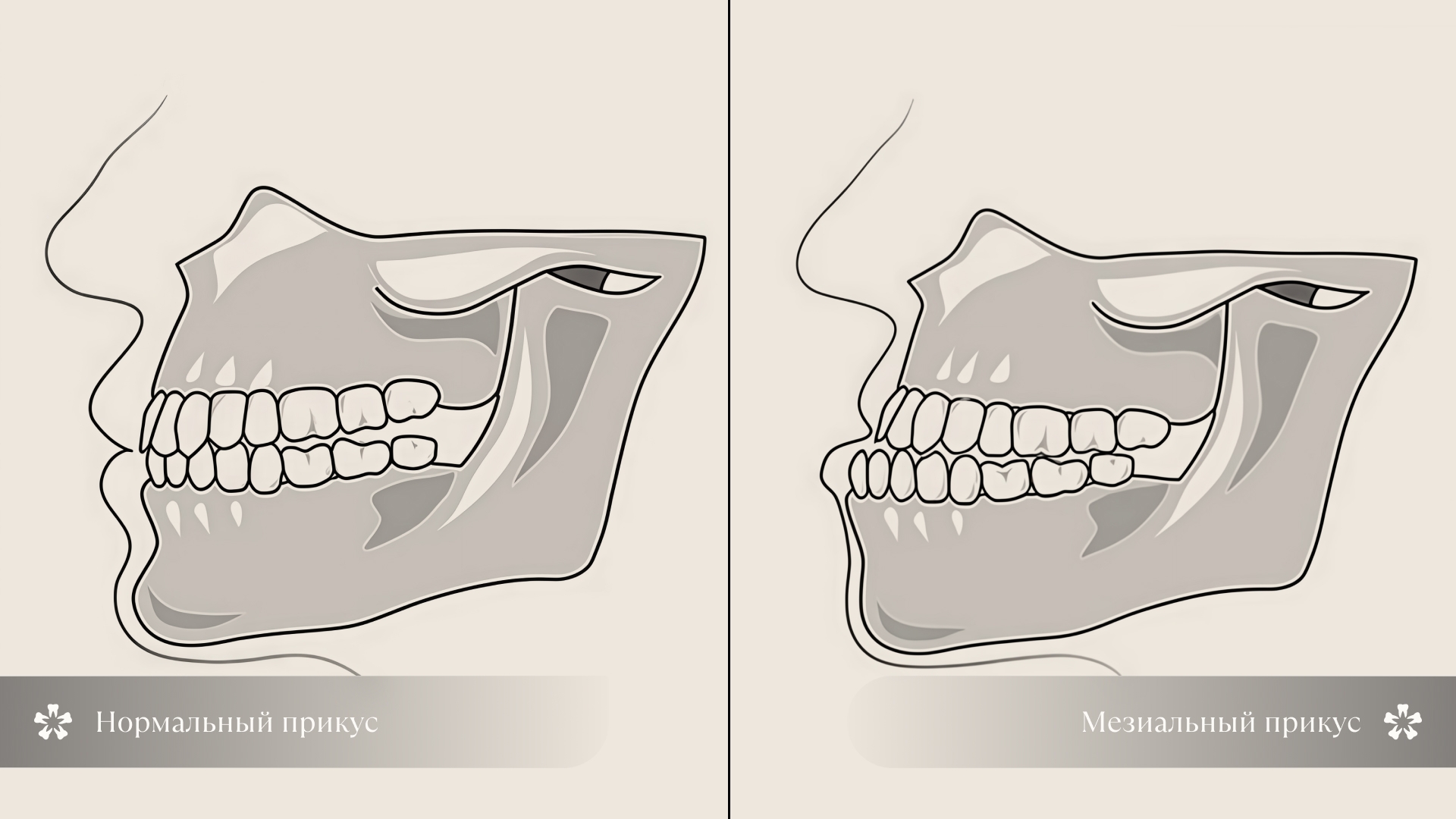 Мезиальный и нормальный прикус