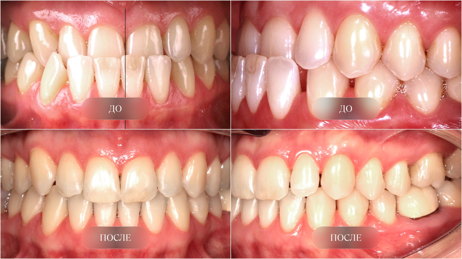 Мезиальный прикус до и после