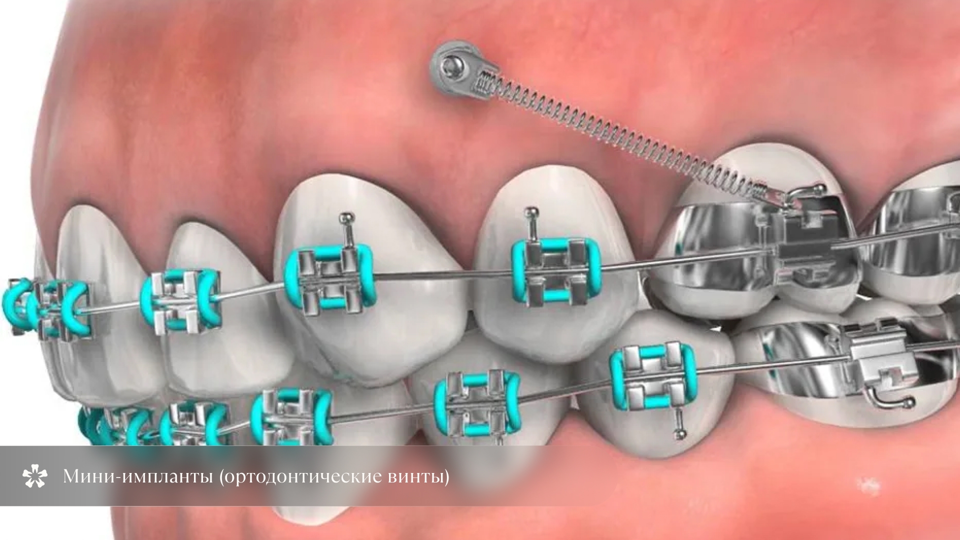 Ортодонтические импланты
